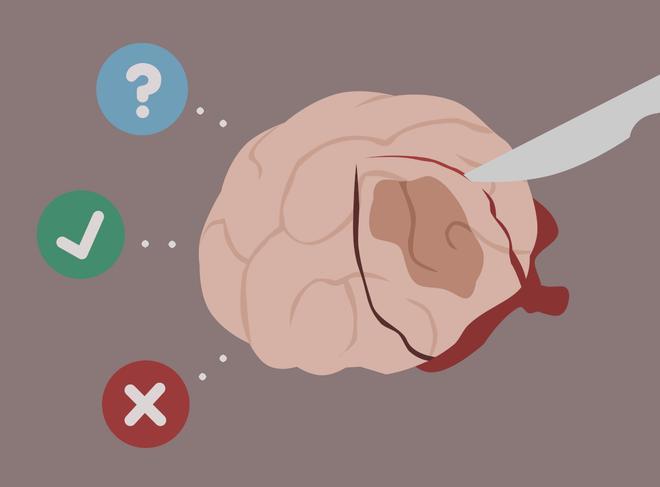Mổ phanh não khi bệnh nhân vẫn đang tỉnh? Phương pháp nghe thì ghê rợn này ngày càng phổ biến và đây là lý do - Ảnh 3. Mổ phanh não khi bệnh nhân vẫn đang tỉnh? Phương pháp nghe thì ghê rợn này ngày càng phổ biến và đây là lý do - Ảnh 3.
